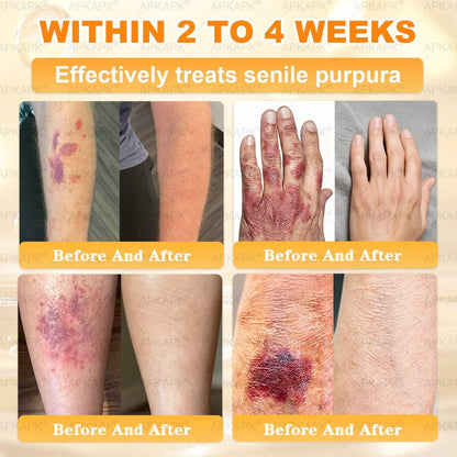 Made and Shipped from USA 🎉𝖠𝖯𝖪𝖠𝖯𝖪® 𝖡𝖾𝖾 𝗏𝖾𝗇𝗈𝗆 𝖲𝗄𝗂𝗇 𝖱𝖾𝗌𝗍𝗈𝗋𝖺𝗍𝗂𝗈𝗇 𝖢𝗋𝖾𝖺𝗆